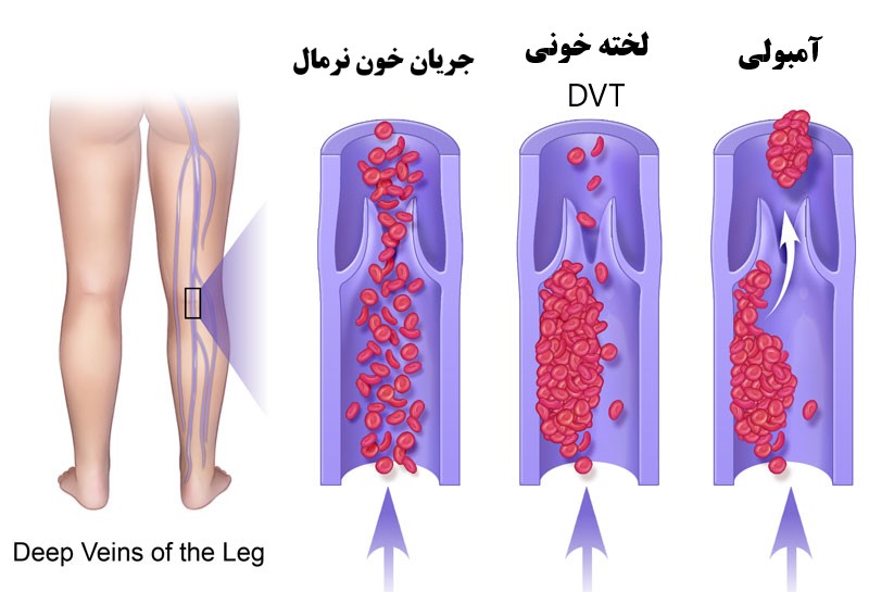 تفاوت ترومبوز و آمبولی